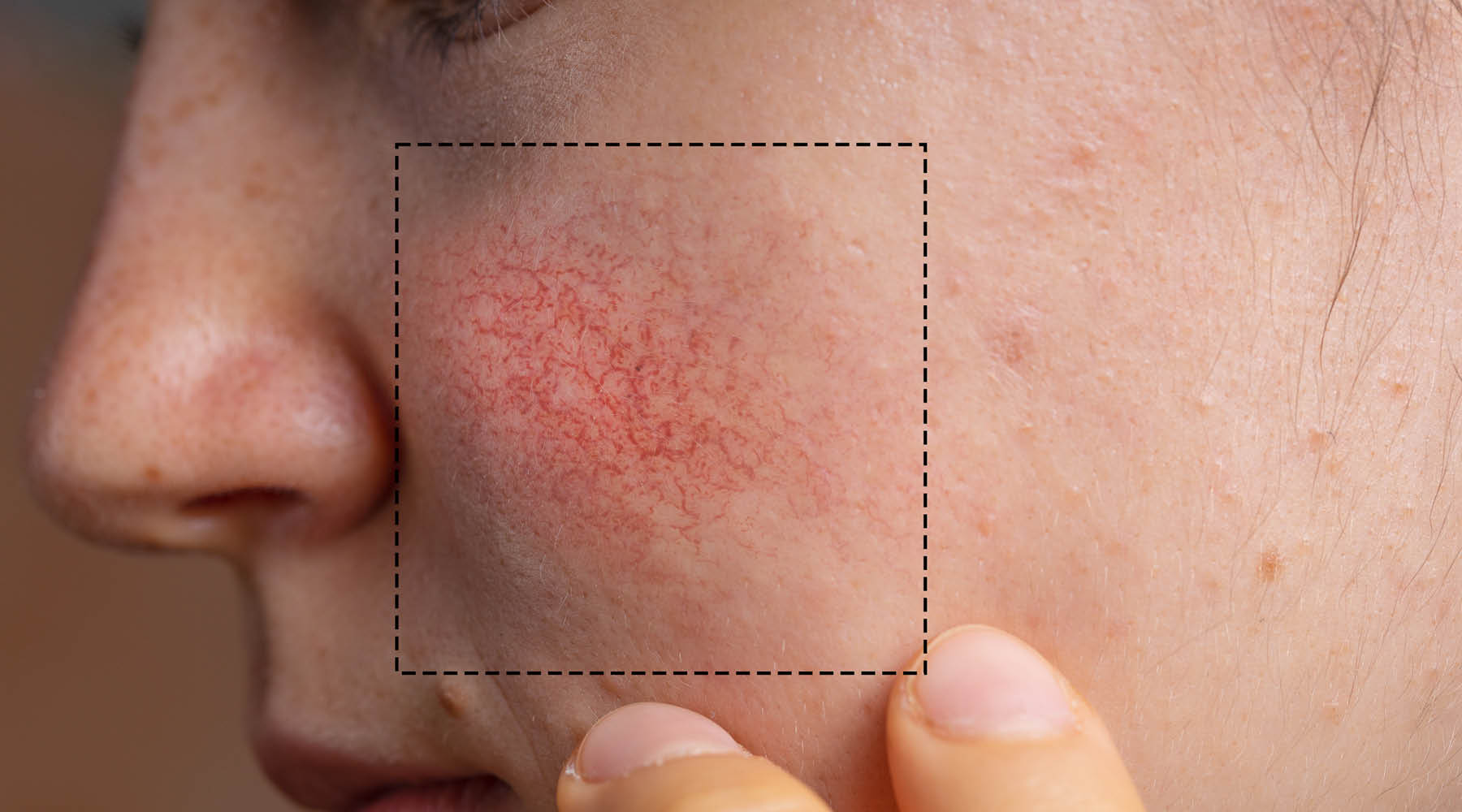7 Hidden Triggers Making Your Rosacea Worse
