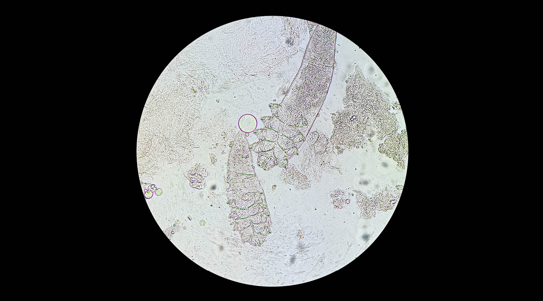 Demodex Mites and Rosacea: The Hidden Trigger Living on Your Skin