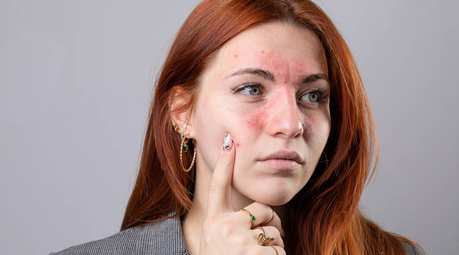 What Is Rosacea, Really?
