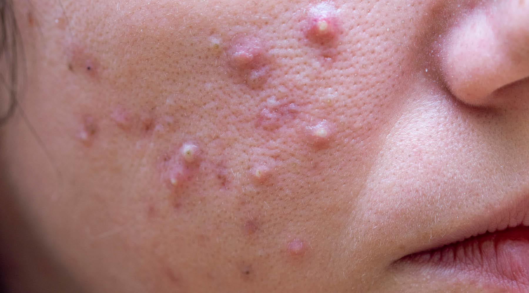 What Causes Acne and Types of Acne: A Deep Dive for Acne Awareness Month