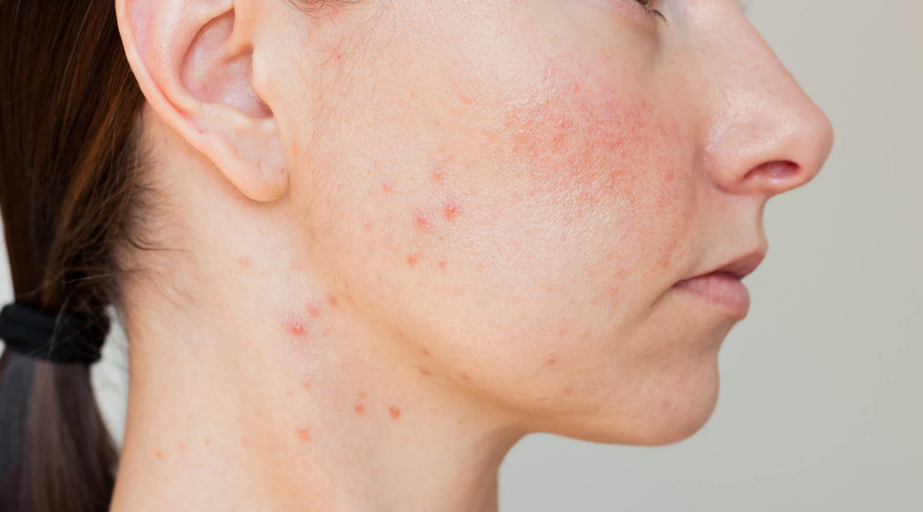 Rosacea and Triggers: Why Your Skin Keeps Flaring and What Actually Helps