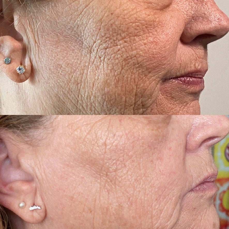 LRT Lift + Rejuvenate + Tone