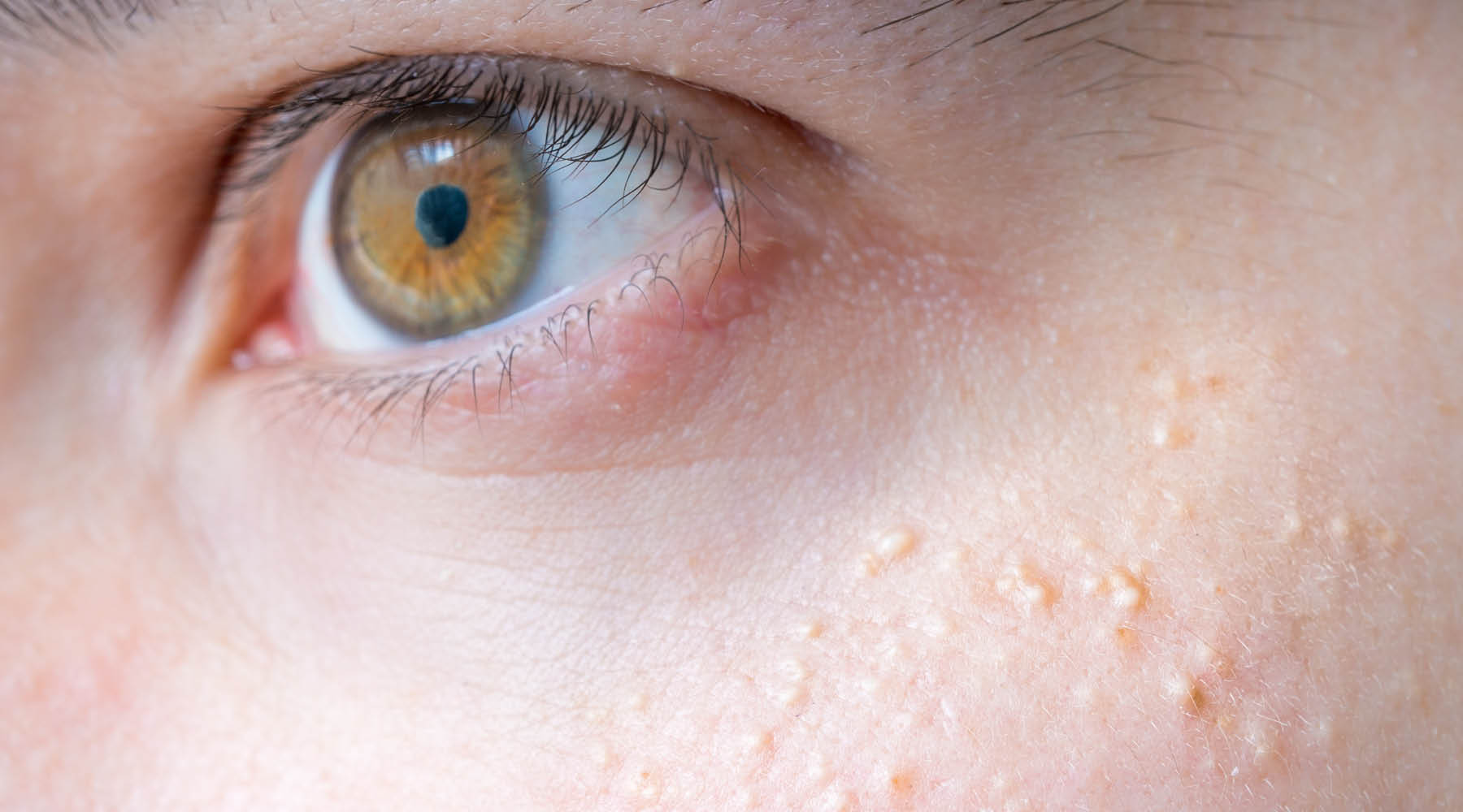 Milia: What Causes It and How to Treat It