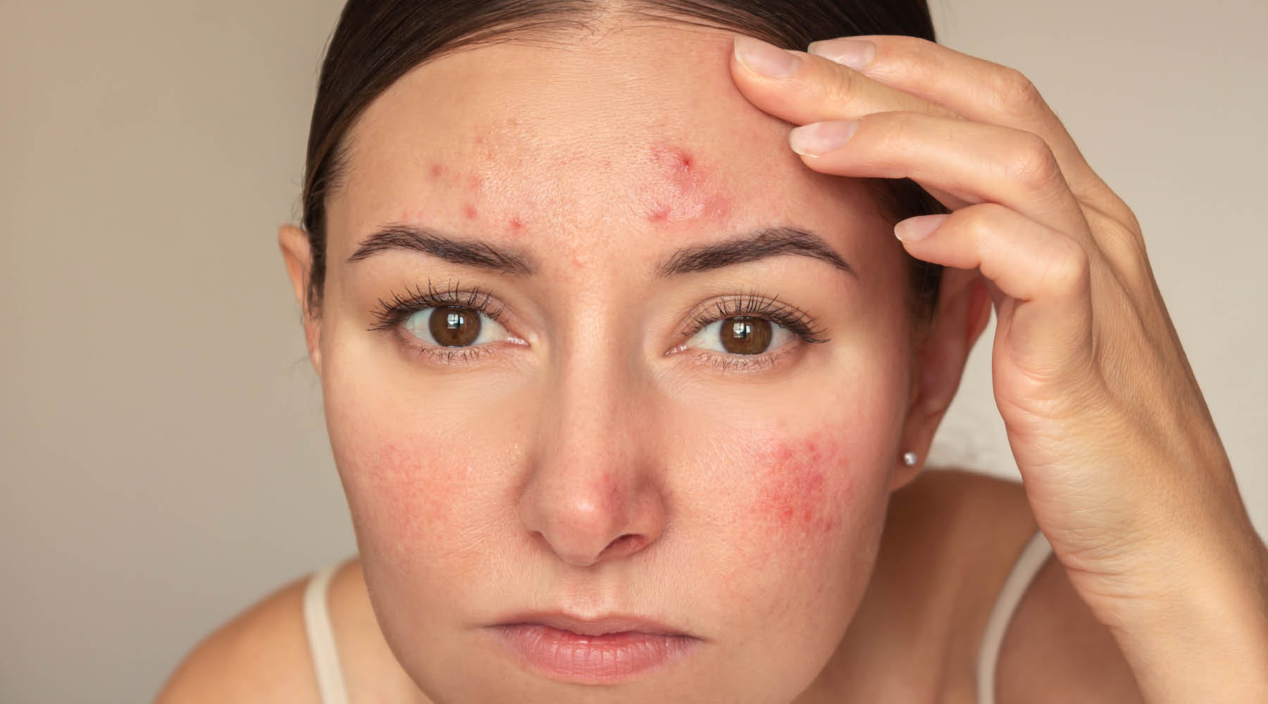 When You Have Both Rosacea and Acne: Why Nothing Works (Until You Treat Them Together)
