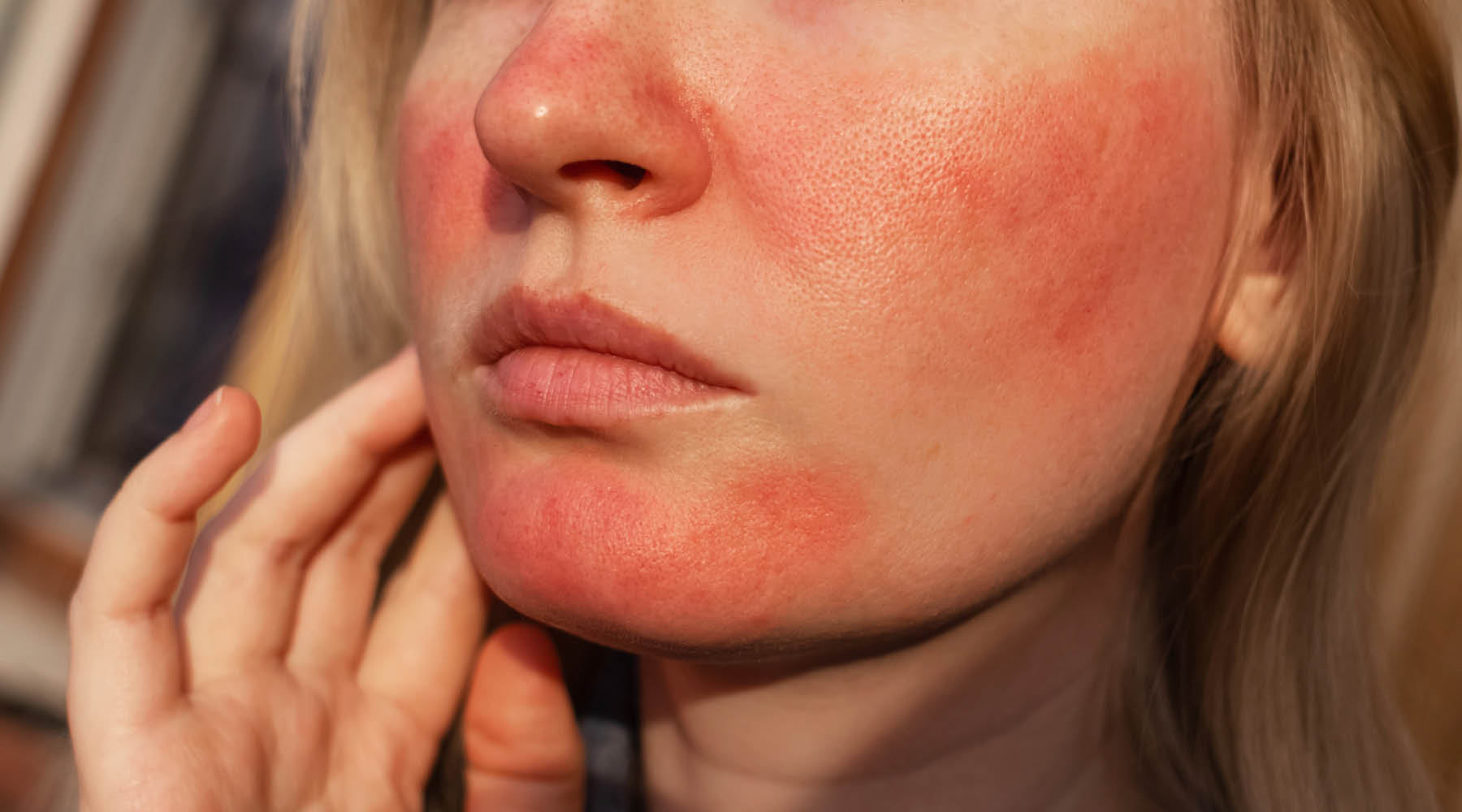 Why Flushing Happens in Rosacea