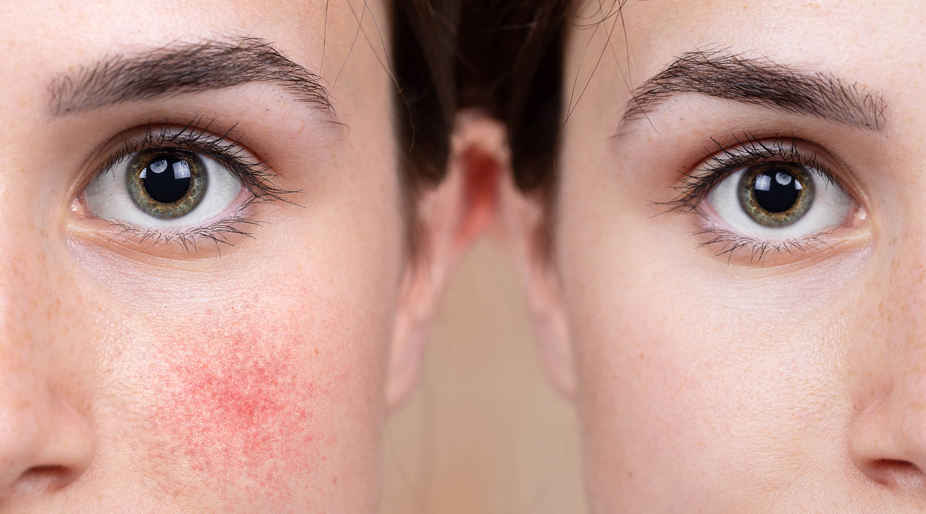 Why Treating All Rosacea the Same Is the Reason Yours Isn’t Improving