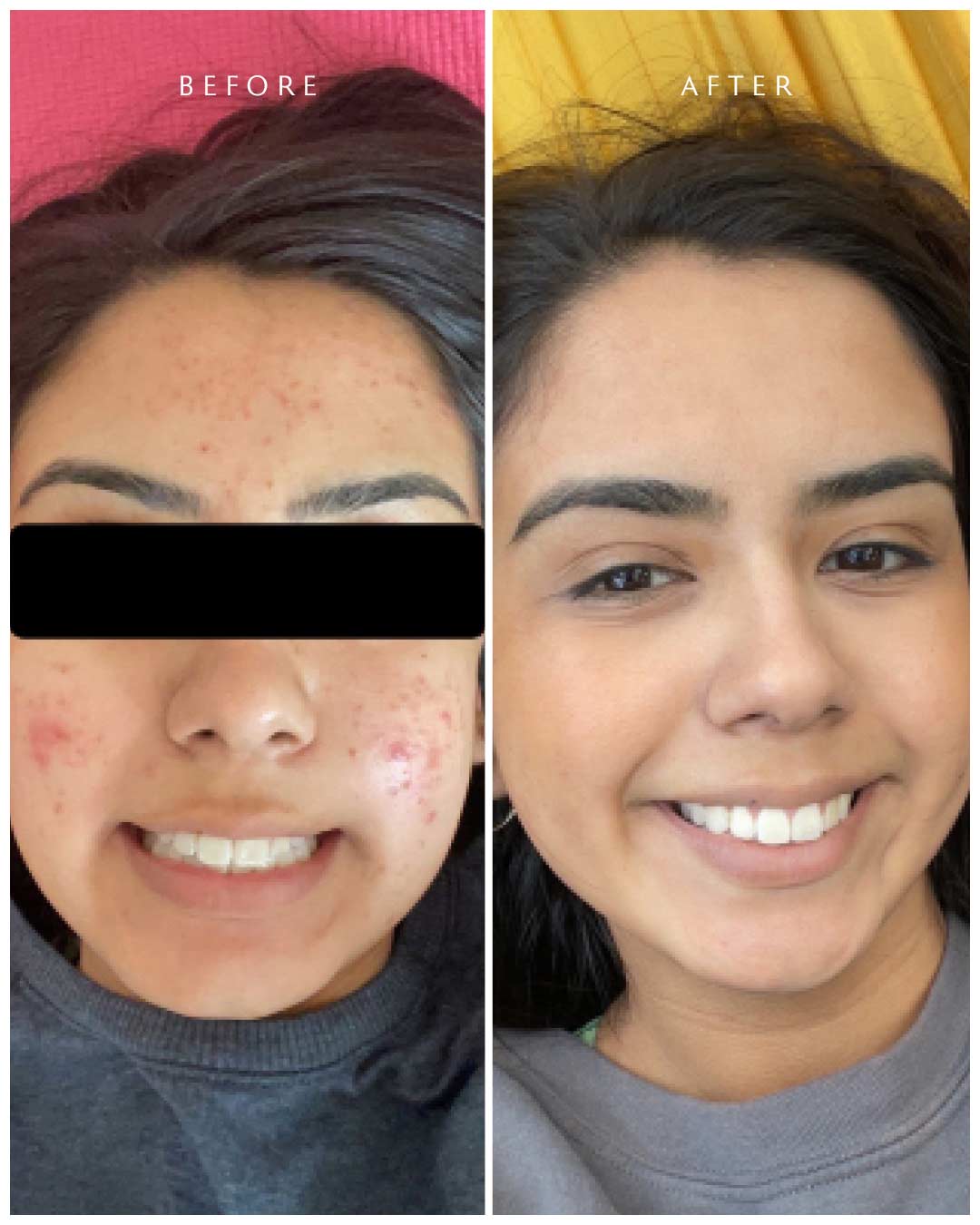 Active Acne Routine